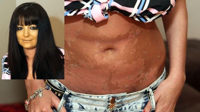 Ingin Kulit Lebih Gelap dengan Tanning, Perut Model Ini Malah Melepuh