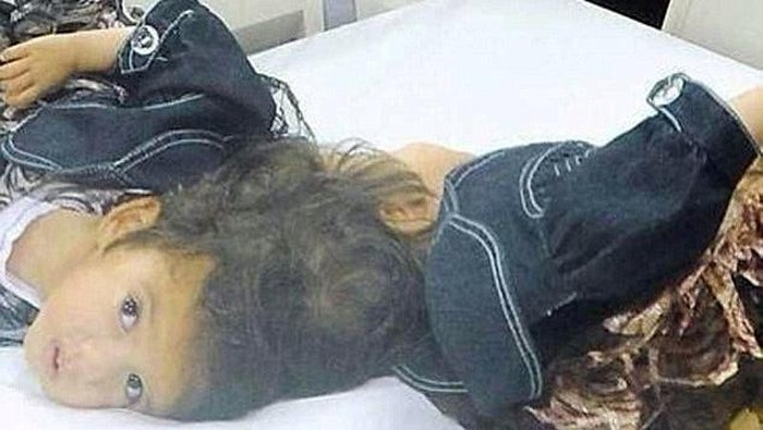 Anak Kembar Dempet Tengkorak Asal Suriah Ini Siap Dipisahkan