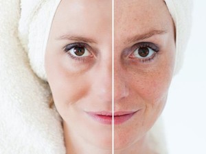 Foto: Before-After Wanita yang Menjalani Perawatan Setrika Wajah