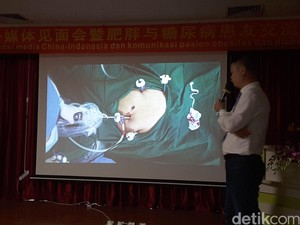 Laparoscopic Sleeve Gastrectomy, Operasi untuk Alternatif Atasi Obesitas