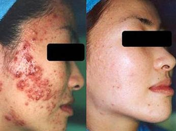 Foto BeforeAfter Wajah Setelah Menjalani Perawatan Bekas Jerawat