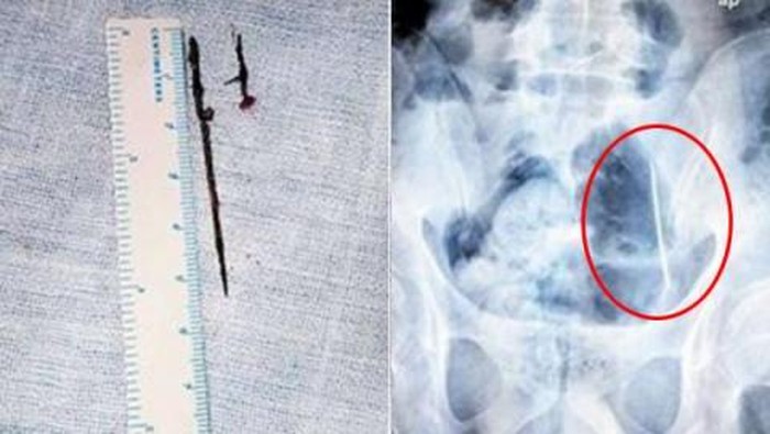 Tangan Mati Rasa, Ternyata Dipicu Dua Jarum yang Nyangkut di Tubuh