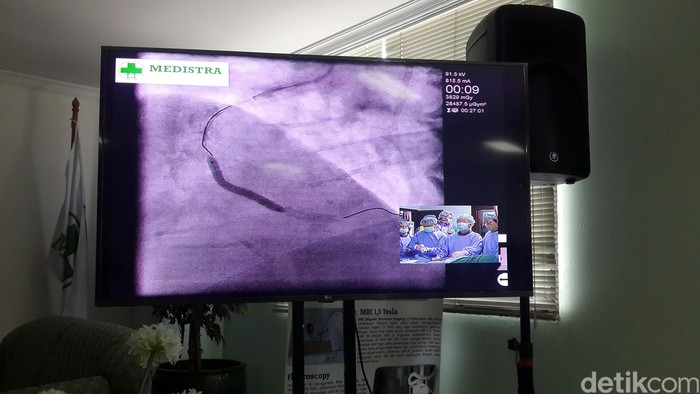 Saat Dokter Indonesia Demonstrasikan Pemasangan Stent Jantung Secara Live