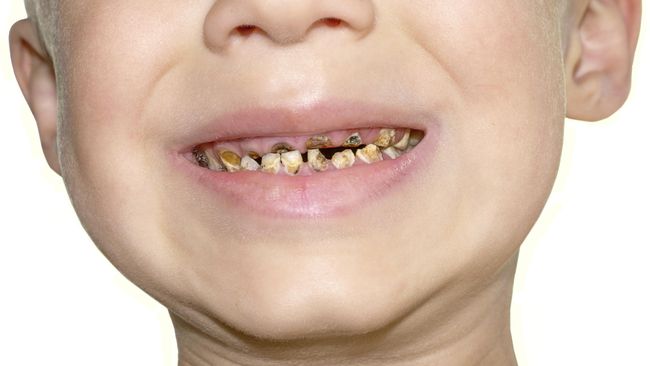 4 Kesalahan Orang Tua yang Nggak Disadari Bisa Bikin Gigi  
