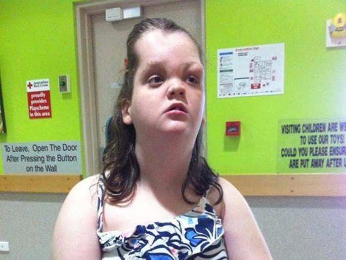 Idap Sindrom Langka, Kaki dan Tengkorak Gadis 19 Tahun Ini Tumbuh Abnormal