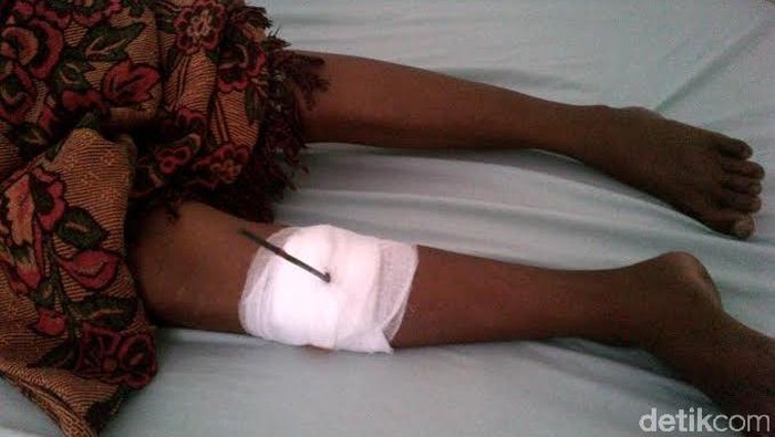 Seorang Ibu di Situbondo Ambruk Terkena Panah Orang Tak Dikenal