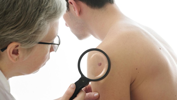 Bisakah laser menghilangkan tanda lahir di kulit? (Foto: Thinkstock) Bisakah laser menghilangkan tanda lahir di kulit? (Foto: Thinkstock)