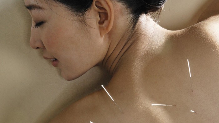 Woman Getting Acupuncture Treatment