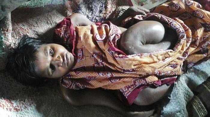 Penyakit Tulang Rapuh Bikin Tubuh Gadis 25 Tahun Ini Seperti Anak-anak