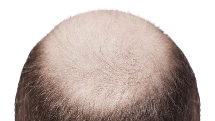Bekerja terlalu lama bisa memicu kebotakan. Foto: thinkstock Bekerja terlalu lama bisa memicu kebotakan. Foto: thinkstock