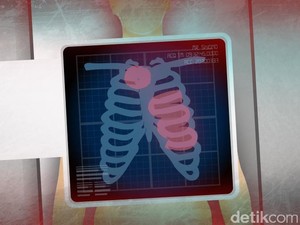 Polri Beberkan Kiprah Siyono dan Kaitannya dengan Hibah Senjata dari Dulmatin