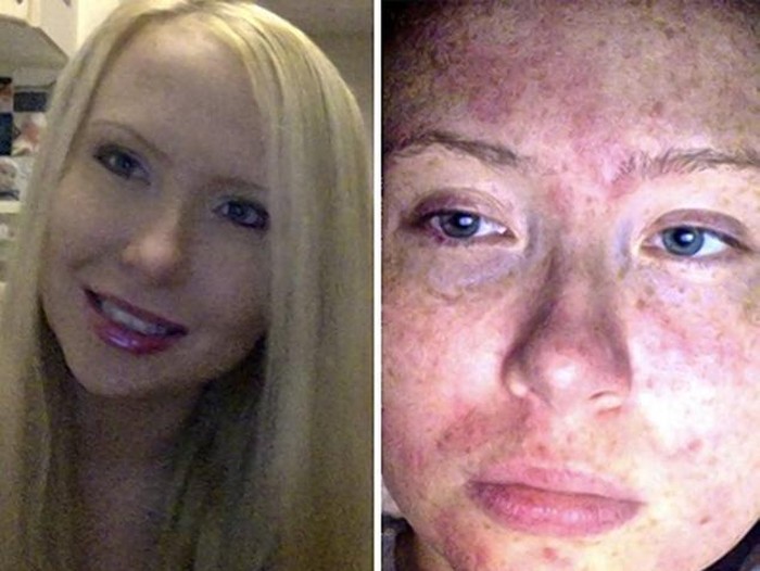 Terlalu Sensitif, Kulit Gatal-gatal Hanya karena Keringat dan Air Mata