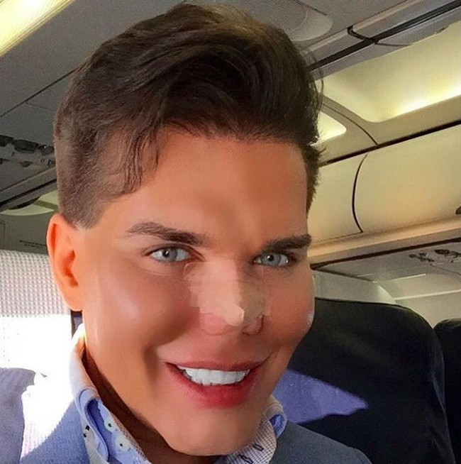 Sebelum kini ganti kelamin sebagai wanita, Jessica saat menjadi Rodrigo telah berulang kali operasi plastik. Untuk bagian hidung saja, dia sudah melakukannya sembilan kali. Dokter pun mengatakan jika dioperasi kembali, bukan tidak mungkin hidungnya akan copot. Tapi dia tidak peduli dan tetap melakukannya. Foto: Instagram