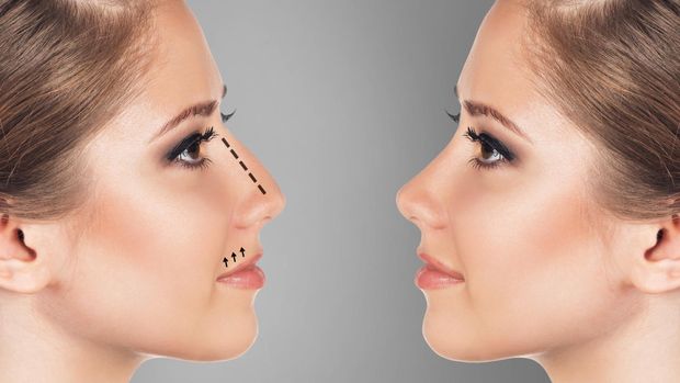 Ilustrasi operasi hidung