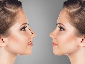 Mancung atau Pesek, Begini Cara Genetik Tentukan Bentuk Hidung
