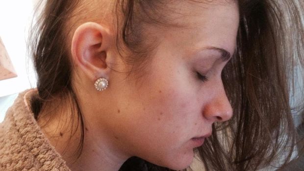 Kena Alopecia Mahasiswi Ini Tegar Jalani Hidup Dengan Kebotakan