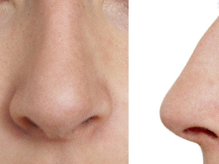 Jika Ingin Permak Hidung, Amankah Bila Dilakukan Berkali-kali?