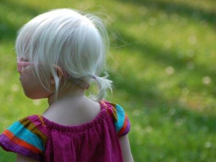 Karakter Putri Elsa di Frozen Bikin Anak dengan Albino Ini Tak Dipandang Beda