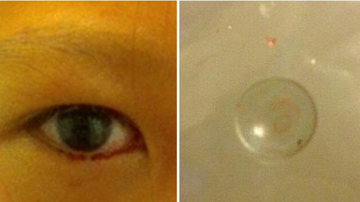 Ada Darah di Air Mata, Ternyata karena Lensa Kontak yang Bersarang 2 Tahun