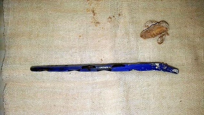 Sikat Gigi Tertelan, Setahun Lamanya Bocah Ini Menahan Sakit Perut