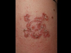 Pakai Henna Hitam, Bocah 10 Tahun Ini Alami Alergi Kulit Parah