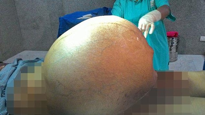 Perempuan Ini Hidup dengan Kanker Seberat Anak Gajah Selama 5 Tahun