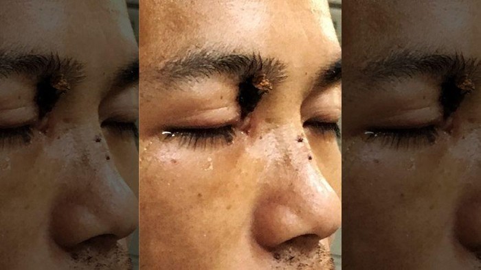 Dokter Sukses Cabut Ranting yang Menancap di Mata Pria Ini