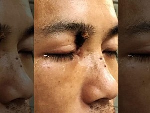 Dokter Sukses Cabut Ranting yang Menancap di Mata Pria Ini