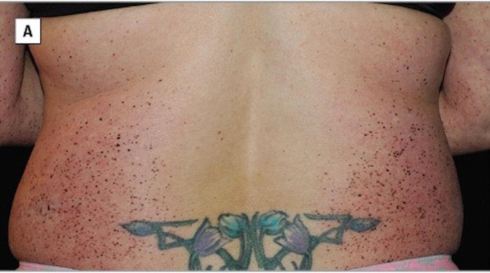 Karena Sebab Misterius, Ribuan Tahi Lalat Tumbuh Mendadak Pada Wanita Ini