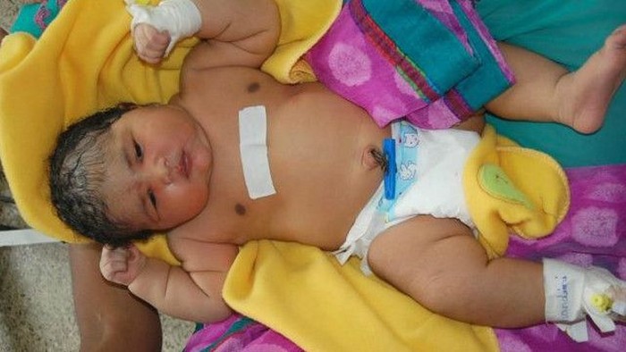 Perempuan India Melahirkan Bayi Seberat Hampir 7 Kg