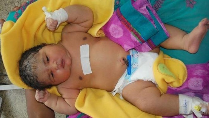 Seorang Ibu Lahirkan Bayi Terberat di India dengan Bobot Mencapai 6,8 Kg