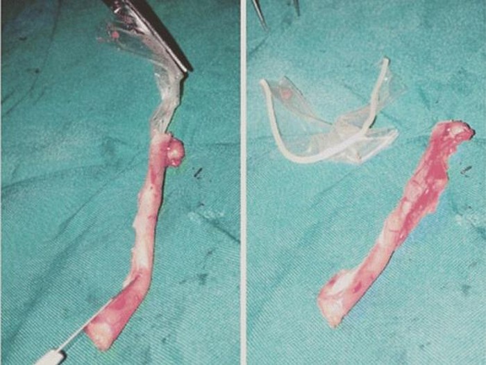 Tak Doyan Makan dan Perut Melilit, Ternyata Ada Kondom Sumbat Usus Buntu