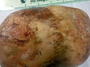 Batu Ginjal 1,5 Kg Berhasil Dikeluarkan dari Tubuh Pria Vietnam Ini