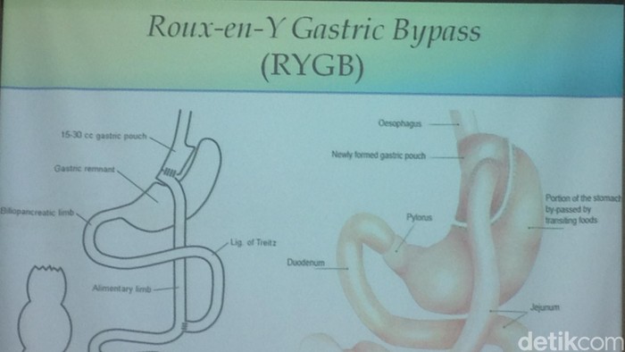 BMI di Bawah 30 Tapi Hendak Jalani Operasi Bariatrik, Bolehkah?
