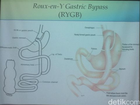 jenis Operasi bariatrik