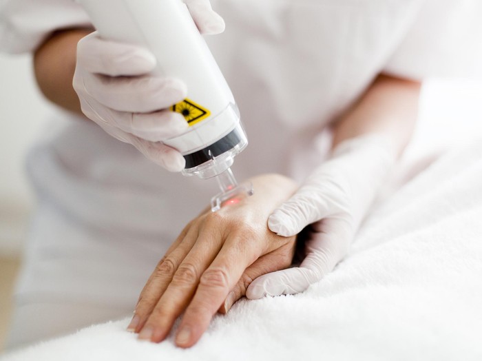 Yuk Ketahui Cara Kerja Terapi Laser untuk Bantu Hilangkan Tato