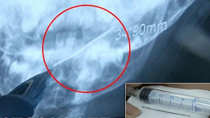 Ngeri! Bayi 1 Tahun Ini Tak Sengaja Telan Jarum Sepanjang 4 Cm