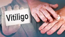 Vitiligo, Penyakit yang Bikin Kulit Memudar Jadi Warna Putih Susu