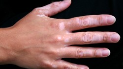 Vitiligo Tak Bisa Sembuh 100 Persen? Ini Kata Dokter