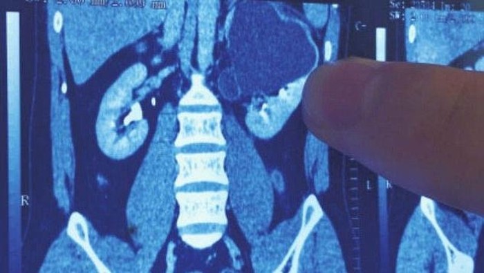 Gara-gara Sakit Perut, Pria Ini Ketahuan Punya 4 Ginjal di Tubuhnya