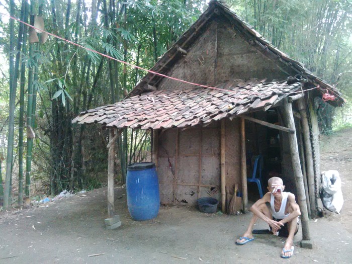 Cerita Mbah Karep Terkena Kanker Kulit