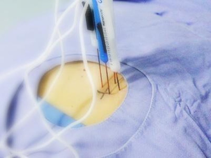 Menaklukkan si Raja Kanker dengan Pisau Nano