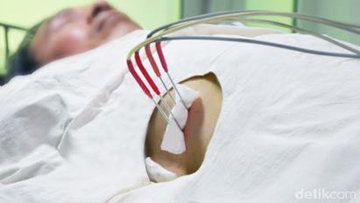 Mengintip Cara Kerja Cryosurgery untuk Membunuh Kanker