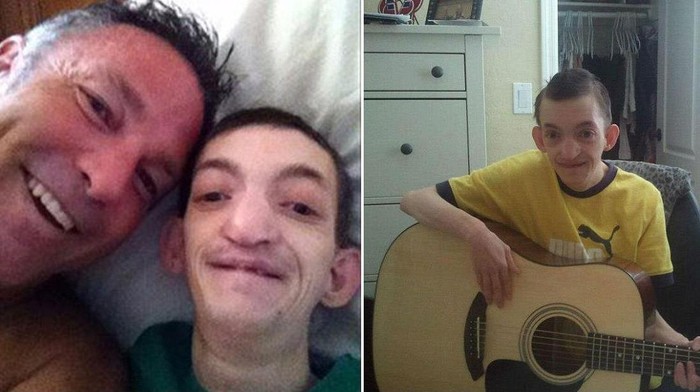 Diprediksi Berumur Pendek, Pengidap Sindrom Langka Ini Rayakan Ultah ke-30