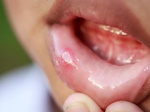5 Tanda Seseorang Terkena HIV