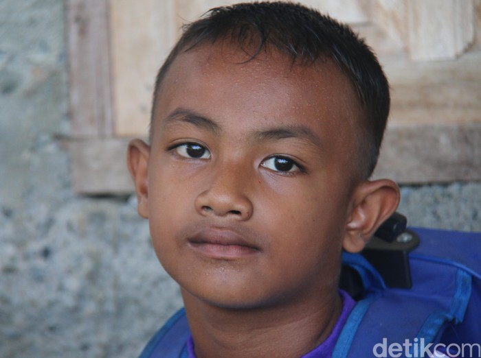 Bocah 5 Tahun yang Berkumis dan Berjenggot karena Kelainan Hormon