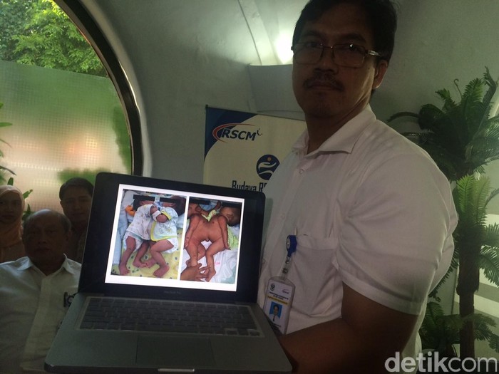 Kembar Siam Dempet Perut Asal Bengkulu Jalani Operasi di RSCM