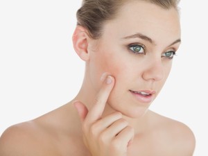 Wajah Berjerawat, Bolehkah Pakai Makeup?