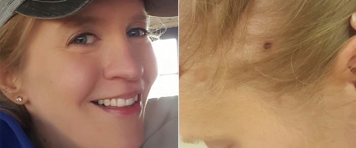 Gara-gara Sindrom Langka, Wanita Ini Puluhan Kali Kena Kanker Kulit