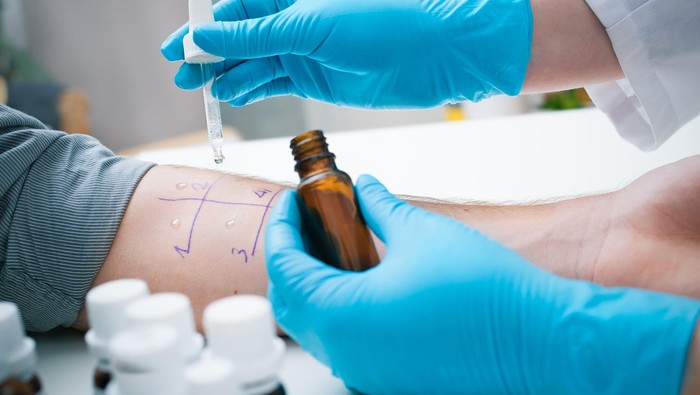 Catat, Ini Pentingnya Melakukan Tes Alergi